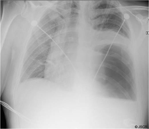 Chest x-ray on 3rd post-op day showing prominent left sided collapse/ consolidation