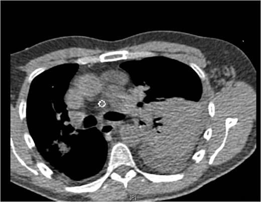 Post-op CT-scan demonstrating the left sided pleural effusion with collapse /consolidation & patchy opacification on the right side.