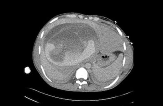 CT scan showing a large liver mass with associated haemorrhage. Detached laminated membrane is visualised.