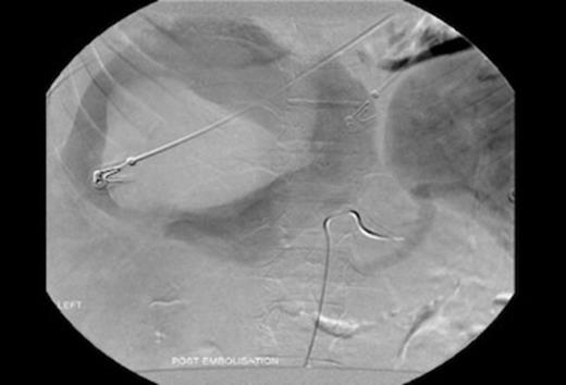 Indirect portography demonstrating a disruption of the intra hepatic right portal vein with extravasation of contrast into a hepatic mass.
