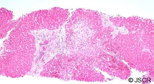 A liver biopsy showing fibrotic change within and outside the portal tracts. Note the organism further magnified in Figures 4&5.