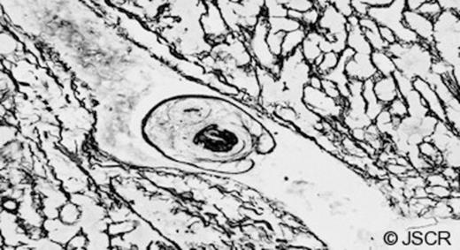 Silver impregnated slide showing a hydatid protoscolex.