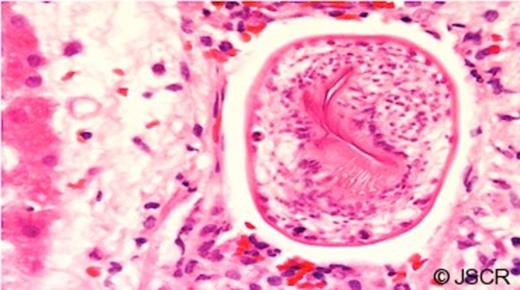 Higher magnification H&E stained image showing a hepatic venule containing a characteristic echinococcal protoscolex with hooklets visible in section.