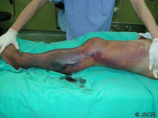 Large hemorrhagic bullae on an extended erythematous area over the left lower extremity