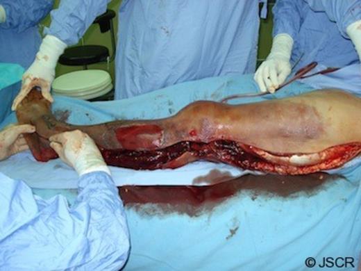 The left lower limb after extensive debridement