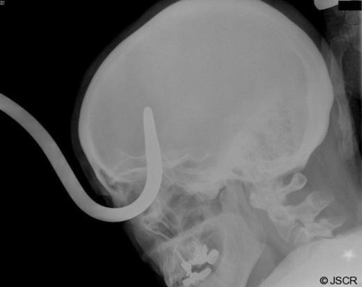 Skull X-Ray