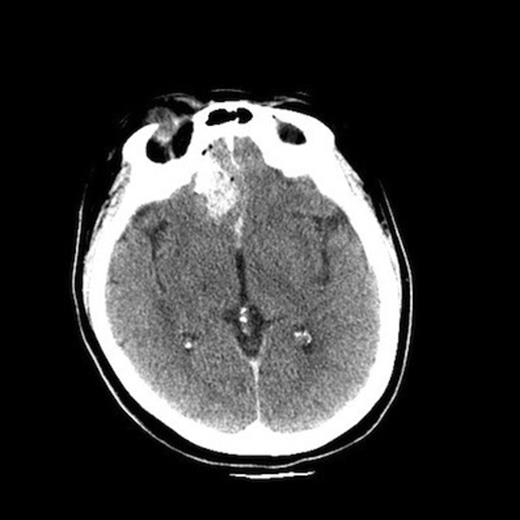 CT angiogram
