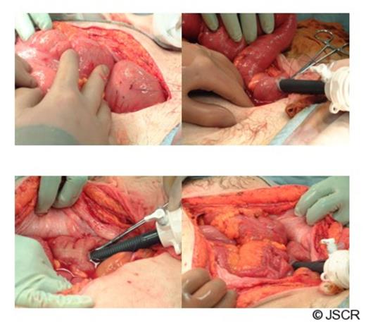 Intra-operative pictures describing the technique