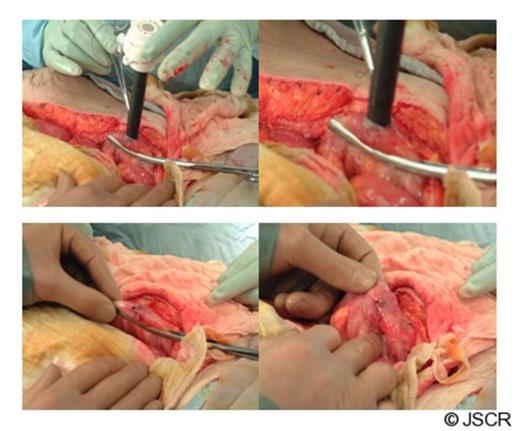 Intra-operative pictures describing the technique
