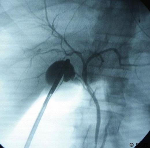 Intraoperative cholangiogram showing 2 cystic ducts. Also appreciated in the image: the common bile duct, the common hepatic duct and the left and right hepatic ducts.