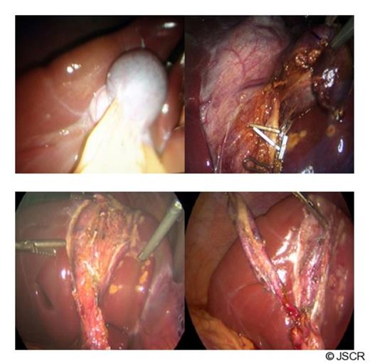 Intraoperative findings