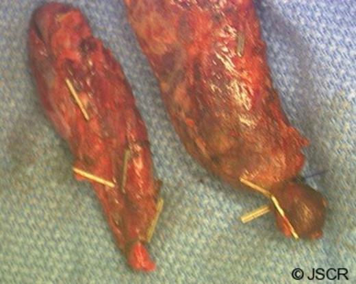 The two gallbladder in the surgical table. The anterior one was slightly larger than the posterior intrahepatic gallbladder.