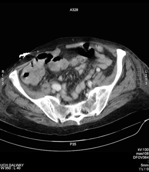 CT abdomen/pelvis illustrating the caecum precontrast.