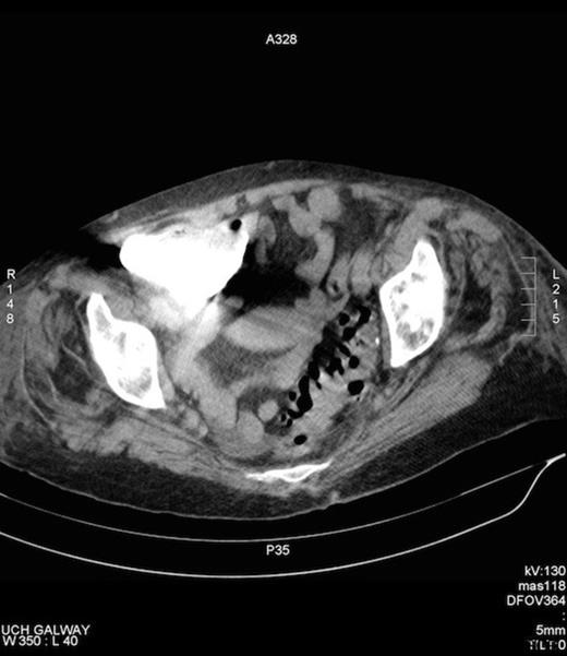 CT fistulogram post injection of contrast via the groin opening. Contrast can be seen to fill the caecum, confirming the presence of a fistula.