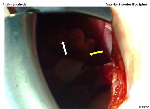 At laparotomy, looking down at the pelvis through a right iliac fossa transverse incision, caecum is seen (white arrow) and the appendix with its tip (yellow arrow) can be seen lying in the inguinal canal.