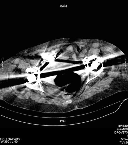 Artefact on CT, secondary to bilateral hip prosthesis, which obscures the appendix.