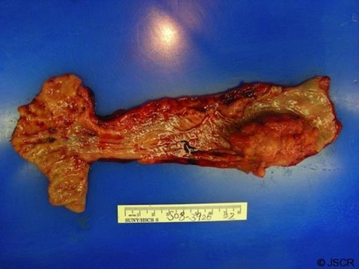 Gross specimen: obstructive exophytic mass in the oesophagus