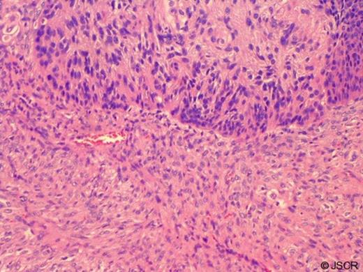 Surgical pathology: squamous cell and sarcomatous cell components of oesophageal carcinosarcoma, hematoxylin and eosin stain at 100x magnification