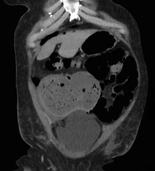 CT scan showing abnormally positioned caecum with caecal pole extending to the left side (A = caecal pole)