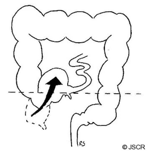 Diagram illustrating folding of caecum in an anterior, medial and superior direction