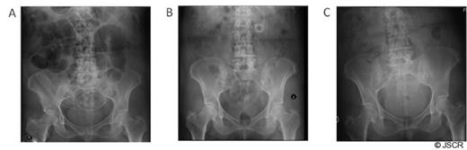 Distal shunt tip placement. (A) Abdominal radiograph demonstrates placement of the distal shunt tip within the peritoneum immediately post-operatively. (B) Distal shunt tip is shown tightly coiled and overlying the left midabdomen. (C) Distal shunt tip is again confirmed to be intra-peritoneal following distal shunt revision.