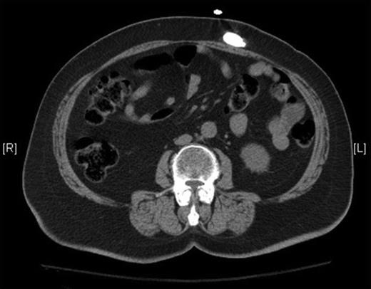 Pre-operative CT radiograph without contrast of the abdomen confirms extra-peritoneal migration of the distal shunt tip.
