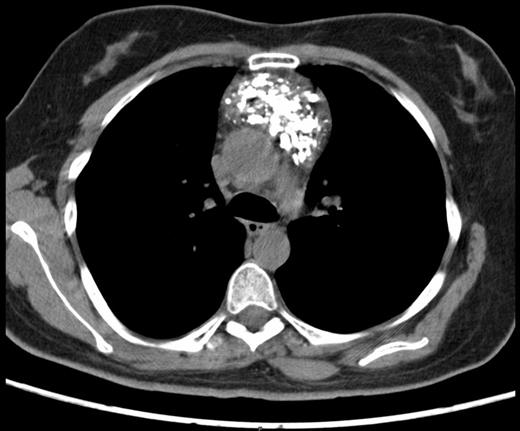 Preoperative chest computed tomography scan revealing a large mediastinal mass - Axial view