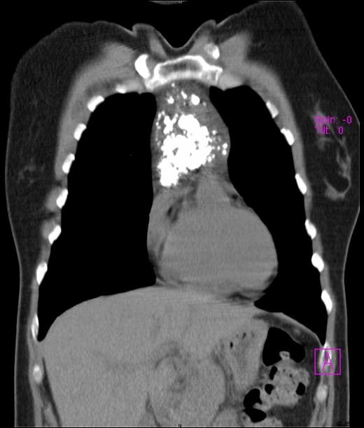 Preoperative chest computed tomography scan revealing a large mediastinal mass - Coronal view