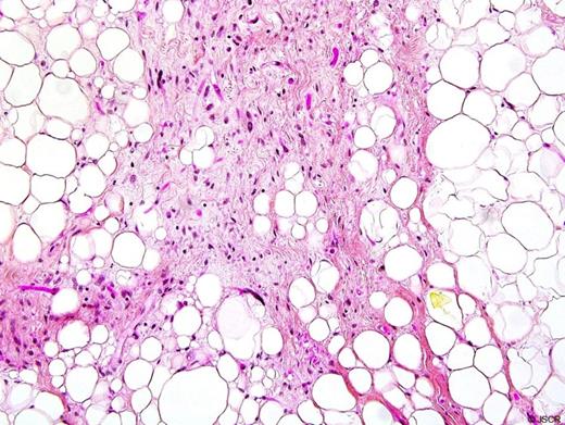 Histological examination of the mass showing adipocytes of varying sizes including univacuolated and multivacuolated lipoblasts with a large hyperchromatic nucleus.