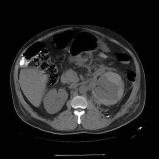 CT scan of abdomen demonstrating a left perinephric capsular hematoma with retroperitoneal stranding