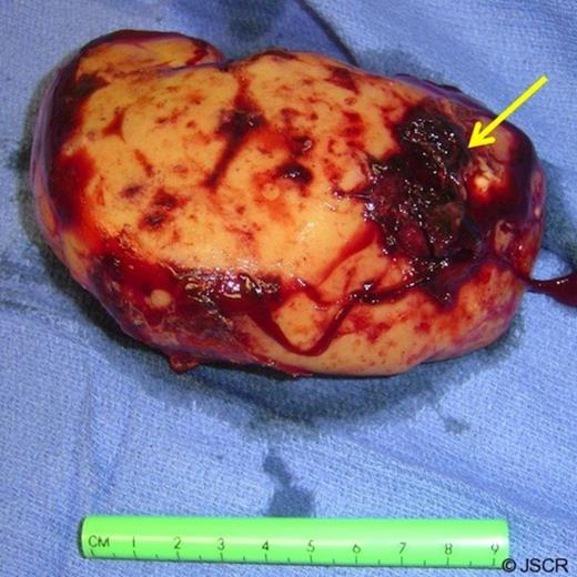Gross specimen following removal demonstrating a ruptured necrotic capsule (arrow)