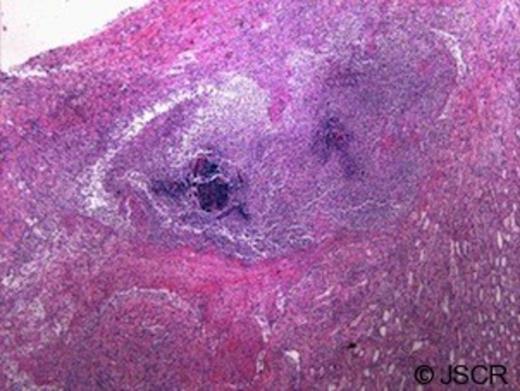 Renal medulla with bacteria, microabscess, and neutrophil reaction (10x magnification)