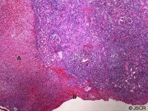 Cortex with necrosis, hemorrhage and fistulous tract (A) associated with capsular hematoma (B) (10x magnification)