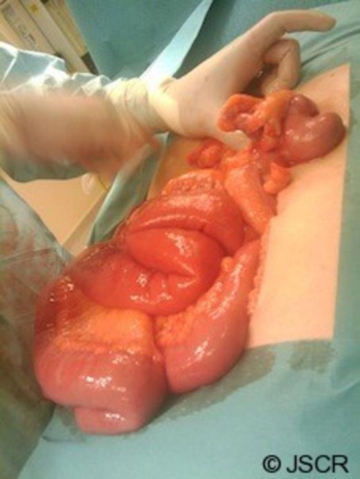 Operative image showing a perforated gangrenous appendix found in the LUQ