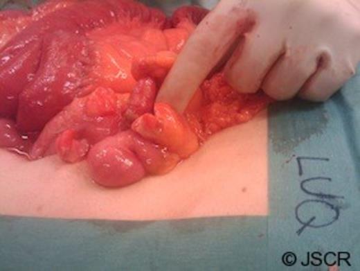 Operative image showing a perforated gangrenous appendix found in the LUQ