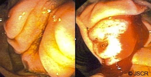 Endoscopic image of a prominent ampulla.