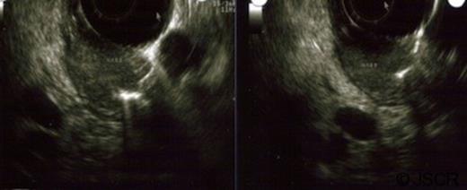 Endoscopic ultrasound depicting a submucosal mass.
