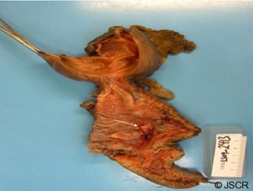Gross specimen (arrow pointing to mass)