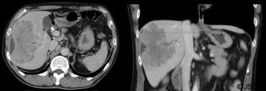 Initial abdominal CT findings; axial and coronal views