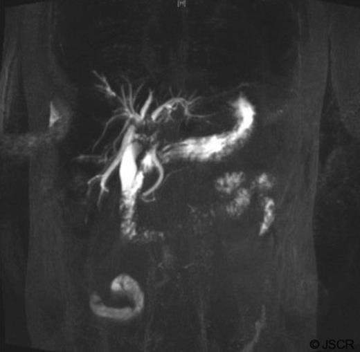MRCP indicating filling defects in left & right hepatic ducts