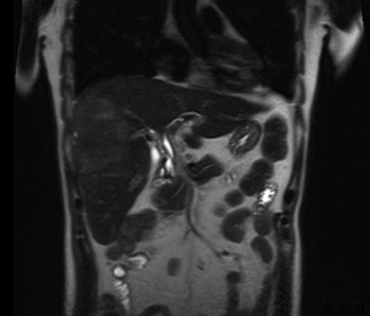 T2 weighted abdominal MRI, coronal view displaying right lobe liver mass.