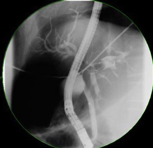 ERCP indicating filing defects in the left hepatic duct system
