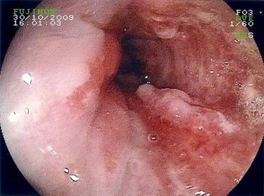 Distal oesophageal adenocarcinoma, viewed on endoscopy.