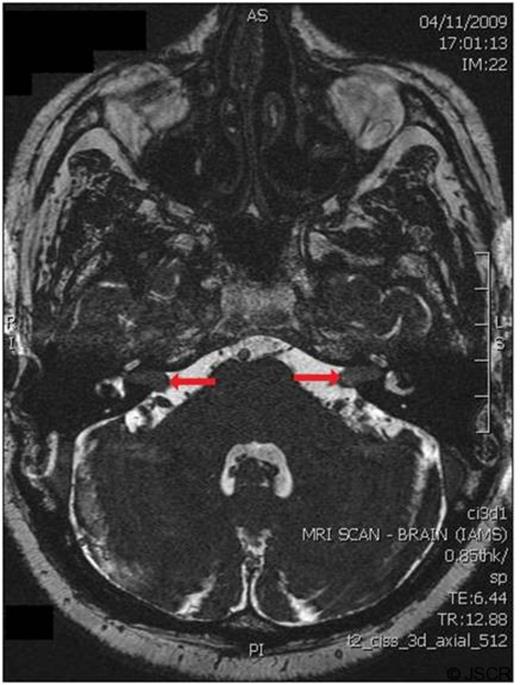 Magnetic resonance imaging at the level of the internal auditory meatus, showing bilateral mass lesions (highlighted by arrows)
