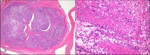 Low power (40x) magnification showing the acoustic nerve within the auditory canal (A), but extensive infiltration with metastatic gastric adenocarcinoma demonstrated on high power (200x) magnification (B). (Haematoxylin and eosin staining after 10% formic acid decalcification)