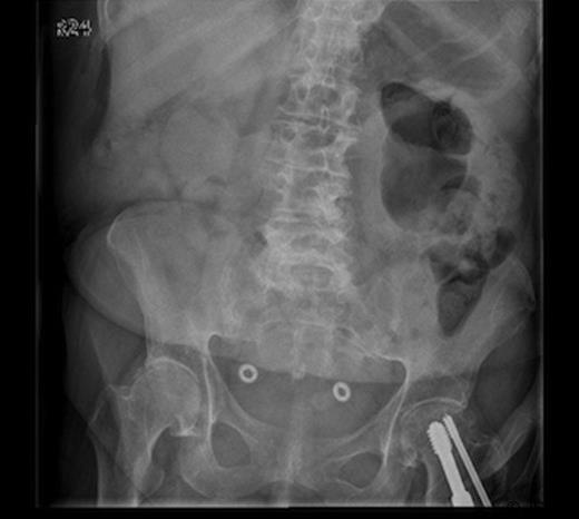 Plain abdominal radiograph showing a non-dilated, gas-filled loop of large bowel in the left upper quadrant, but no free gas within the peritoneal cavity