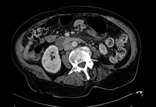CT showing the caecal pole to be situated in the left upper quadrant, with evidence of fat stranding between the caecum and pancreas