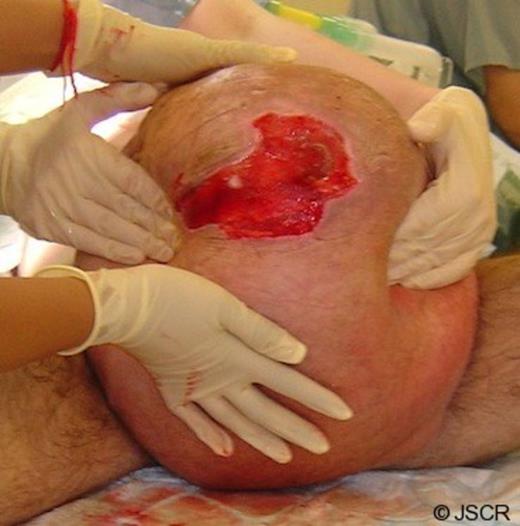 The giant inguinoscrotal hernia demonstrating the scrotal ulcer
