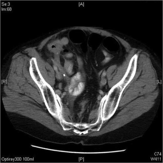 CT scan demonstrating the presences of inflammation in the right iliac fossa, with some distension of the appendix tip