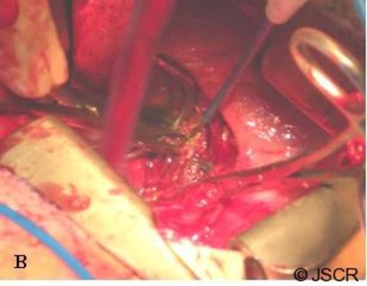 Dissection of the caudate lobe of the liver to gain proximal and distal control of the IVC. The tumor is being retracted cephalad with a clamp.